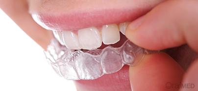 Aparelho dentário invisível: o que é e como funciona?
